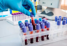 Blood Test Predicts Disaster Years Early Gloved hand handling blood samples in a laboratory